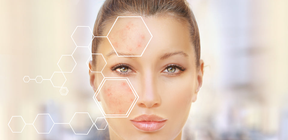 Foods that Cause Breakouts